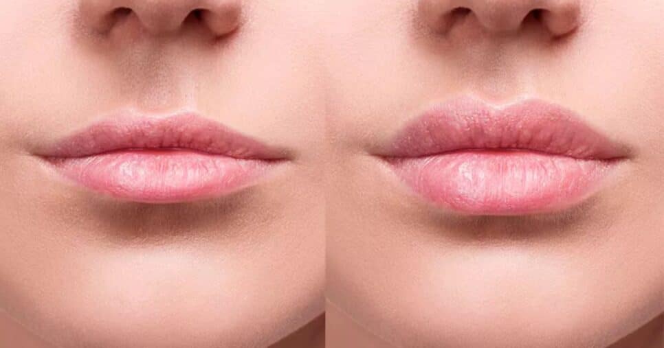 Receita natural com 2 ingredientes deixa lábios super volumosos (Reprodução/Dream Plastic/Canva)