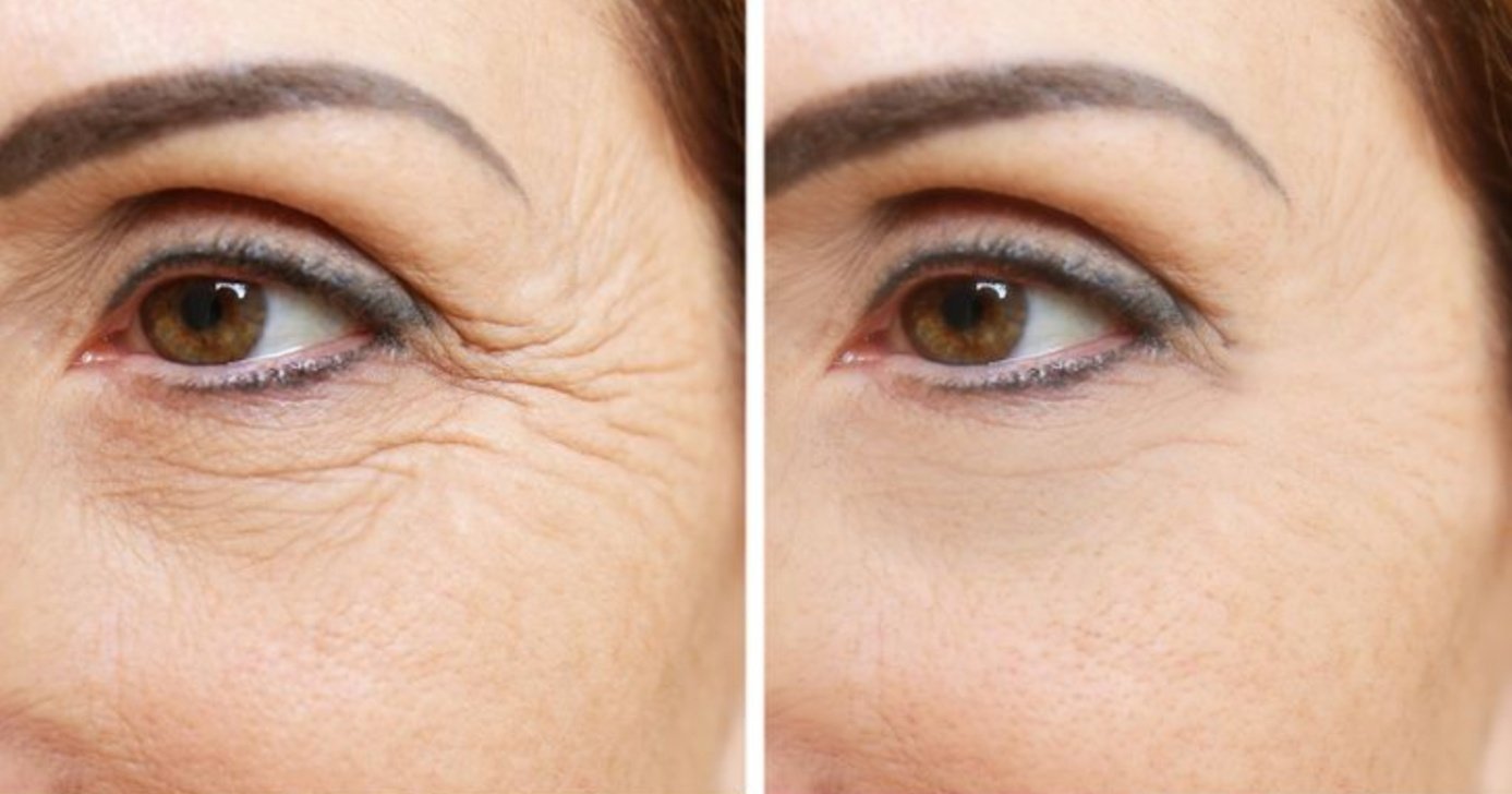 Creme natural arranca rugas de mulheres 40+ - (Foto: Internet)