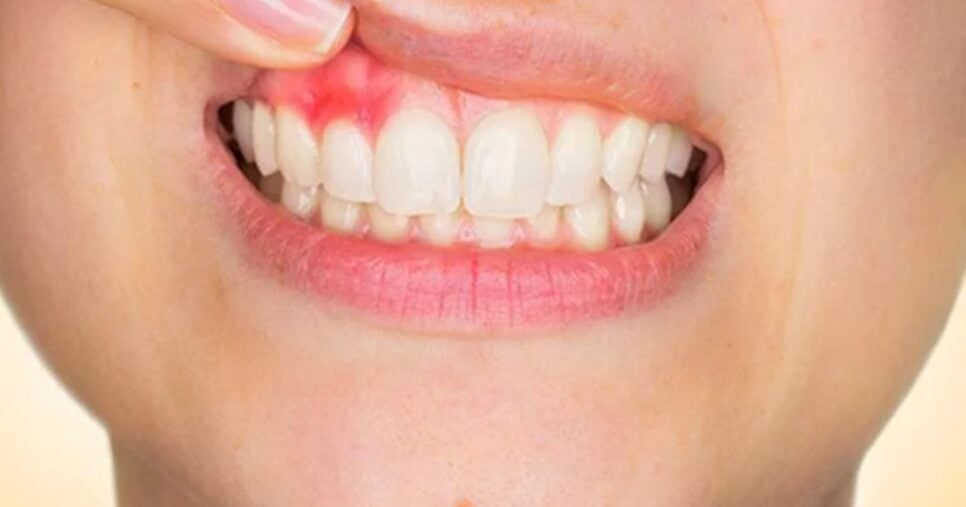 Câncer na boca precisa de atenção especial das mulheres (Foto: Reprodução/ Internet)
