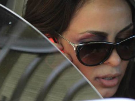 A cantora apareceu com olho roxo (Foto: Reprodução)