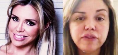 Renata Banhara ficou com o rosto inchado. (Foto: Reprodução)