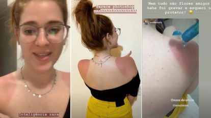 Ana Clara expõe queimaduras de sol e impressiona internautas