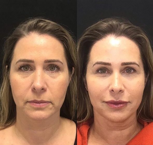 Antes (à esquerda) e depois de Andréa Sorvetão (Foto: Reprodução/ Instagram)