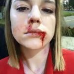 Alice Wegmann aparece com o rosto deformado e explica o que ocorreu: ‘Estava torcendo para acontecer logo’