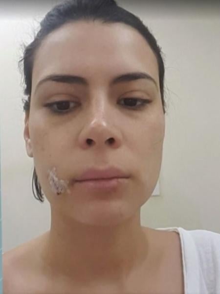 Michelle Loreto, da TV Globo, mostrou pontos no rosto após mordida de cachorro (Reprodução: TV Globo)