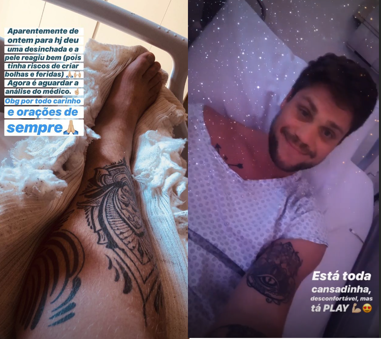 Ex-participante do BBB Breno Simões fraturou o tornozelo (Foto: Reprodução/ Instagram)