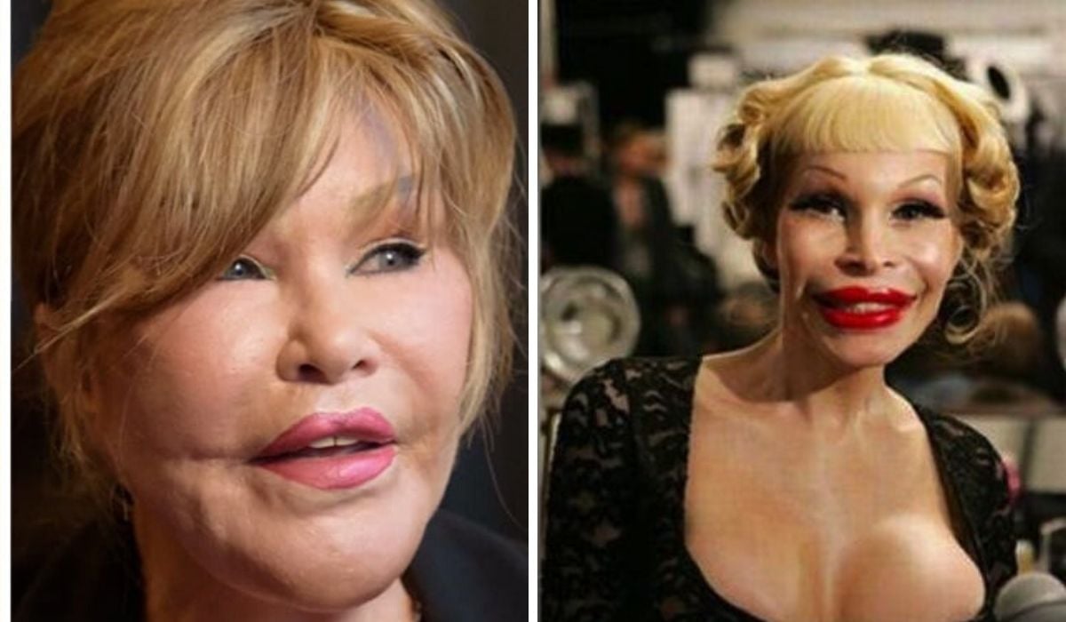 Deu ruim! As celebridades que fizeram cirurgia plástica que deram totalmente errado