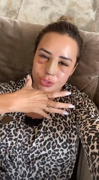 Letícia Santiago com os olhos inchados e olho roxo (Foto: Reprodução)