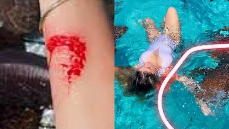 Influencer Ana Bruna Avila mostra como ficou a mordida de tubarão depois do susto (Montagem: TV Foco)