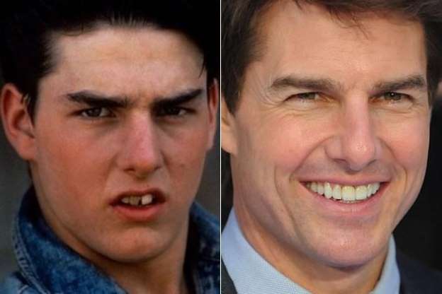 Famosos antes e depois da fama: Tom cruise (Foto: Reprodução)
