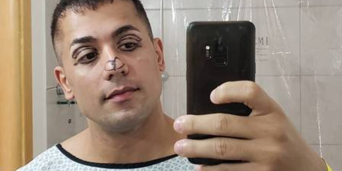 Tiago retiurou as pálpebras e alfinou o nariz (Foto: Reprodução)