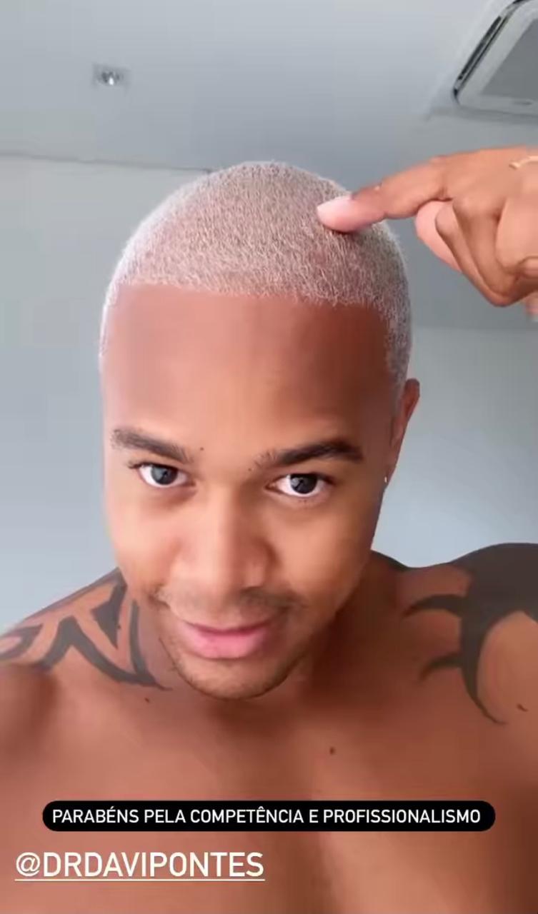 Artista aparece sem camisa para celebrar transplante capilar (Reprodução: Instagram)
