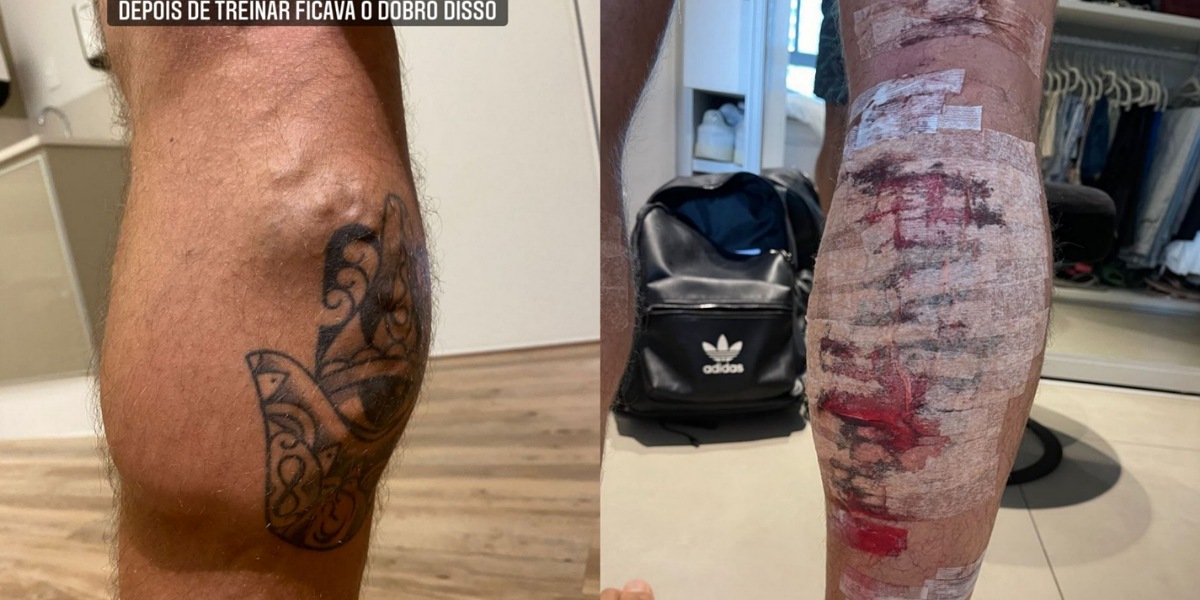 Jonas Sulzbach mostra antes e depois da cirurgia para retirada de varizes - Foto: Reprodução/Instagram