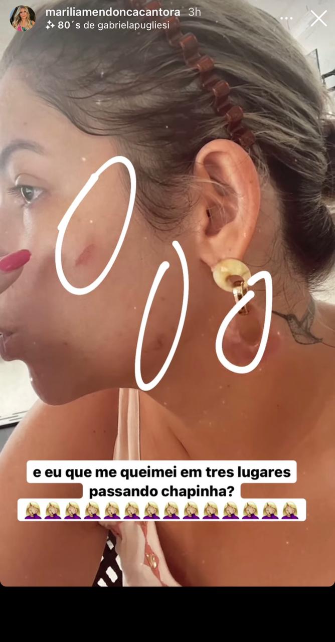 Marília Mendonça sofreu acidente doméstico e imagens foram divulgadas