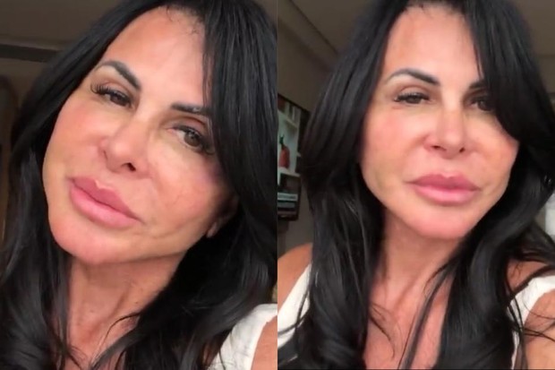 Gretchen passa por nova cirurgia no rosto 