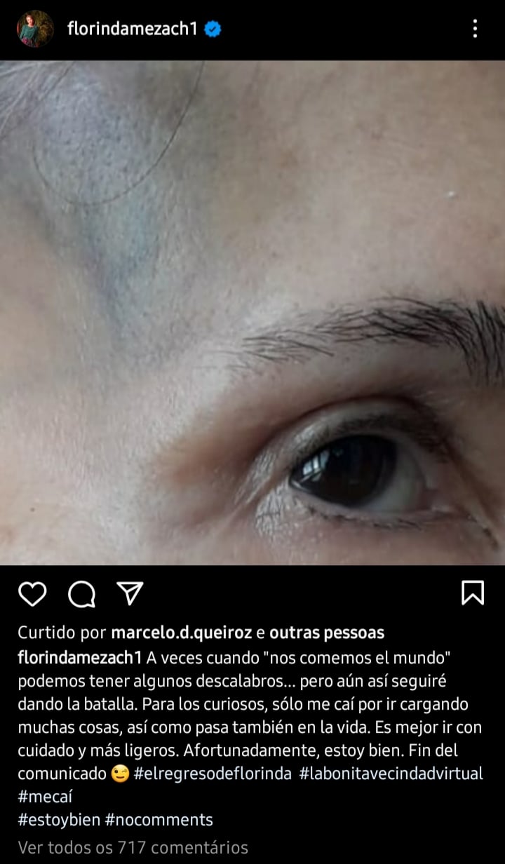 Atriz Florinda Meza, sofre acidente e posta foto nas redes sociais (Foto: Reprodução)