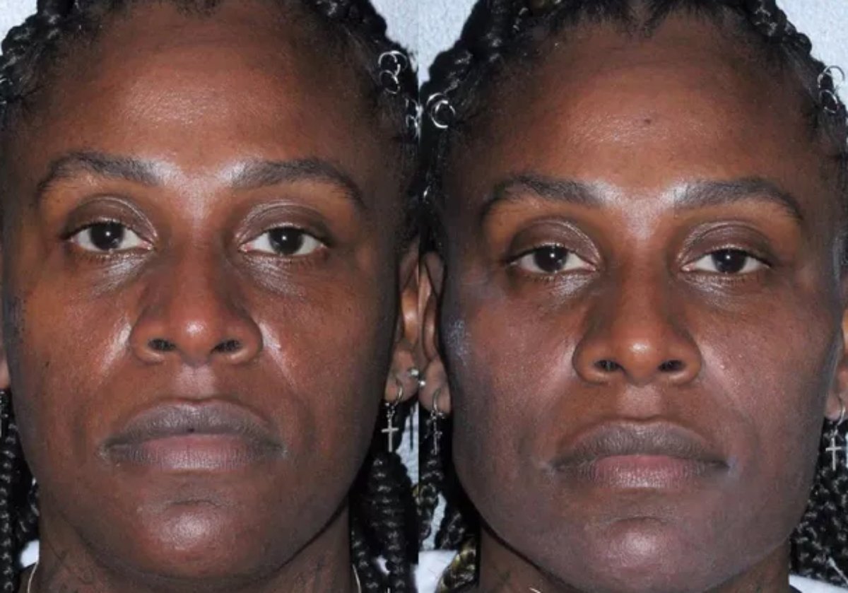 Pepê e Neném fazem harmonização facial (Reprodução)