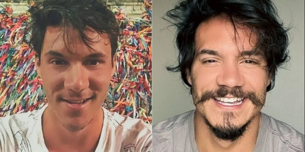 Eliezer antes e depois da harmonização facial (Foto: reprodução)
