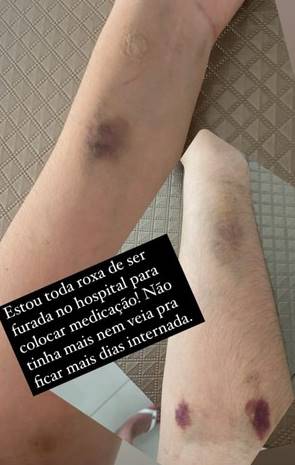 Andressa Urach mostra hematomas pelo o corpo após internação (Imagem: Reprodução / Instagram Stories) Andressa Urach mostra hematomas pelo o corpo após internação (Imagem: Reprodução / Instagram Stories)