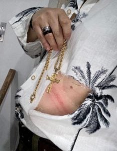 Adriane Bonato mostra hematomas após assalto contra ela e Claudia Rodrigues (Foto: Reprodução)