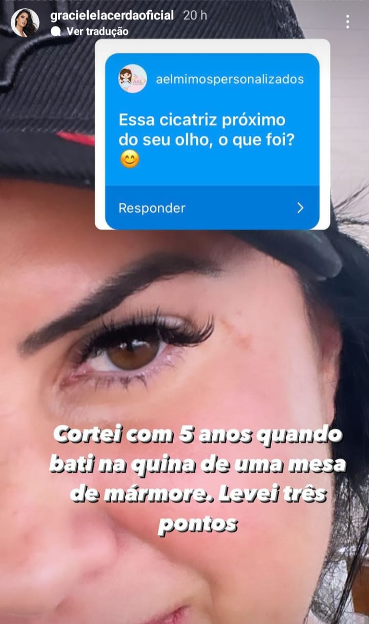 Graciele explicou motivo de cicatriz permanente no rosto (Foto: redes sociais) 