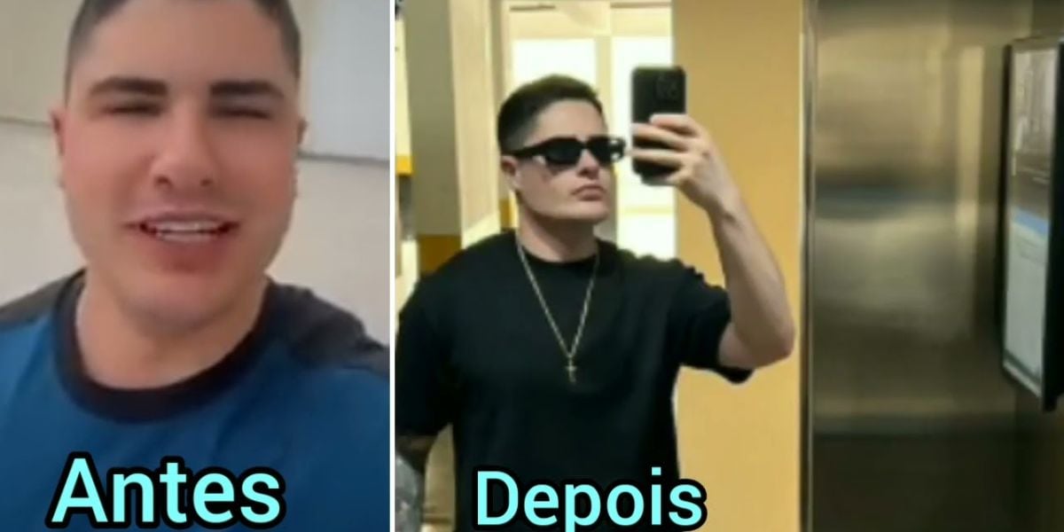 Lucas Souza antes e depois de harmonização facial (Foto> Reprodução Instagram) Lucas Souza antes e depois de harmonização facial (Foto> Reprodução Instagram)