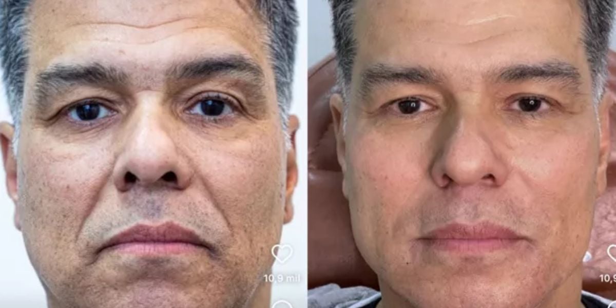 Ator Maurício Mattar antes e depois da  harmonização facial - Foto: Reprodução Instagram