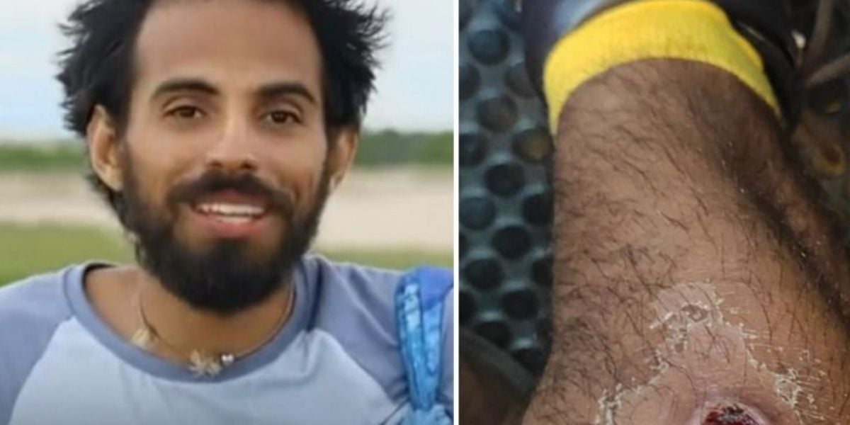 Lucas Santana mostrou ferimento infeccionado nos bastidores de "No Limite"