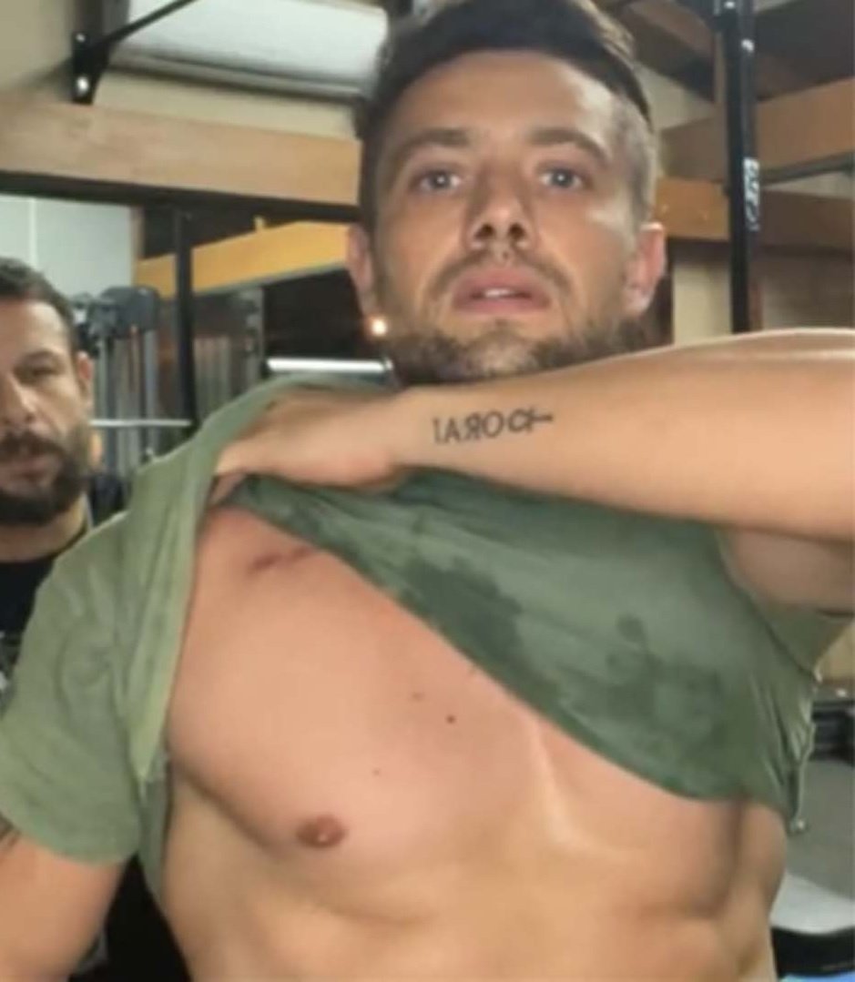 Rafael Cardoso exibindo a cicatriz de sua cirurgia (Foto: Reprodução)