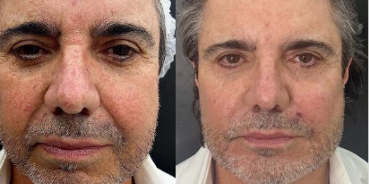 "Milagre": João Kleber mostra antes e depois de harmonização facial
