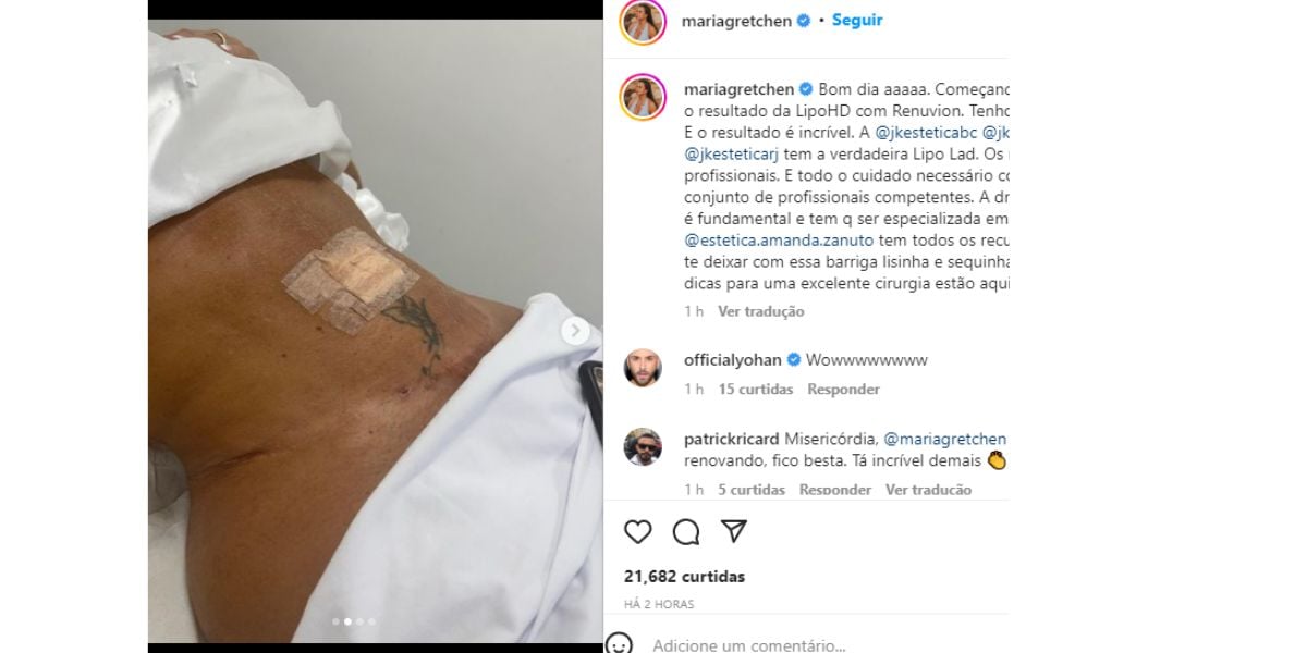 Gretchen - resultado - lipo