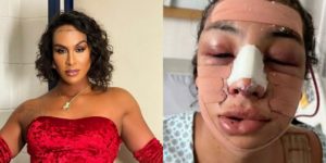 Linn da Quebrada, a Lina,faz cirurgia de feminilização e mostra resultado (Foto: Reprodução / Internet)