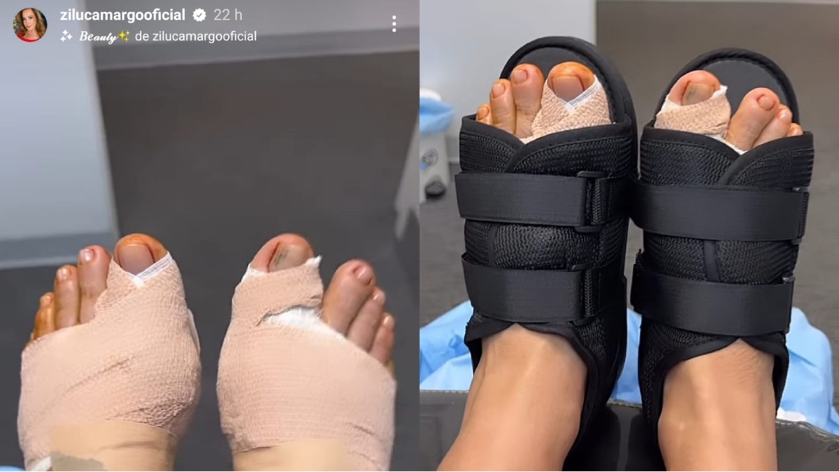 Zilu Godoy mostra seus pés enfaixados, confirma que houve necessidade de cirurgia e mostra roxo de pancada