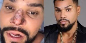 Naldo Benny tem nariz tomado por necrose e fica à beira de perdê-lo após procedimento errado em clínica - Foto Reprodução