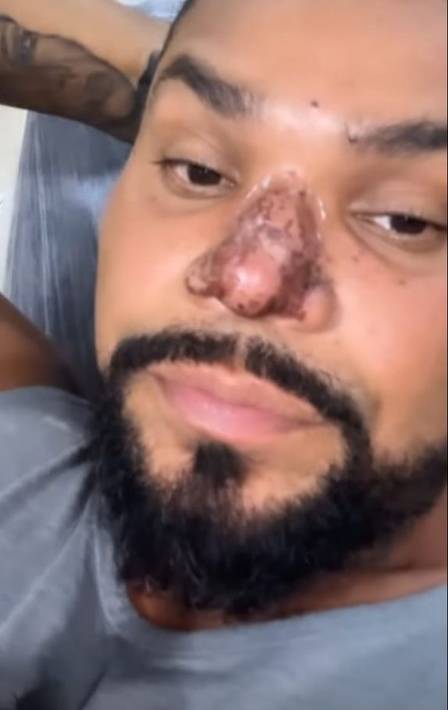 um princípio de necrose no local - Foto Reprodução Instagram - Foto Reprodução Instagram