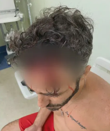 Machucado na cabeça de Thiago Rodrigues (Foto: Divulgação)