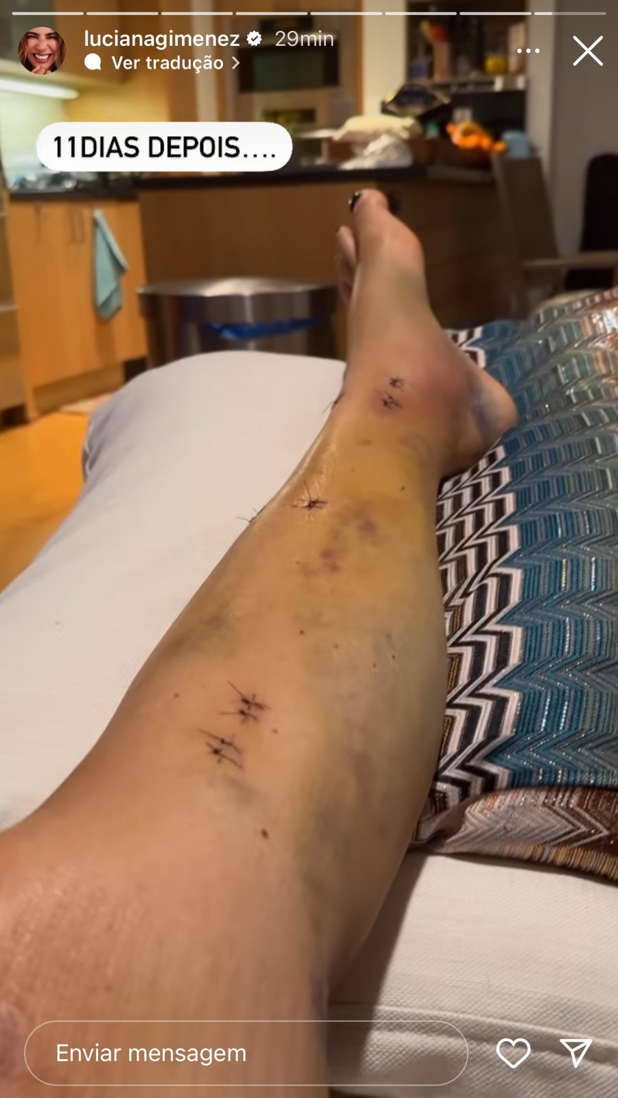 Perna de Luciana Gimenez (Reprodução)