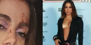 Anitta surgiu ensanguentada e assustou os fãs (Reprodução - Instagram)