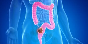 Câncer do intestino é um dos mais comuns do Brasil; conheça os principais sintomas (Foto: Reprodução)