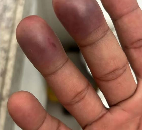 Cantor Nathan ficou com a mão completamente roxa - Foto Reprodução Internet