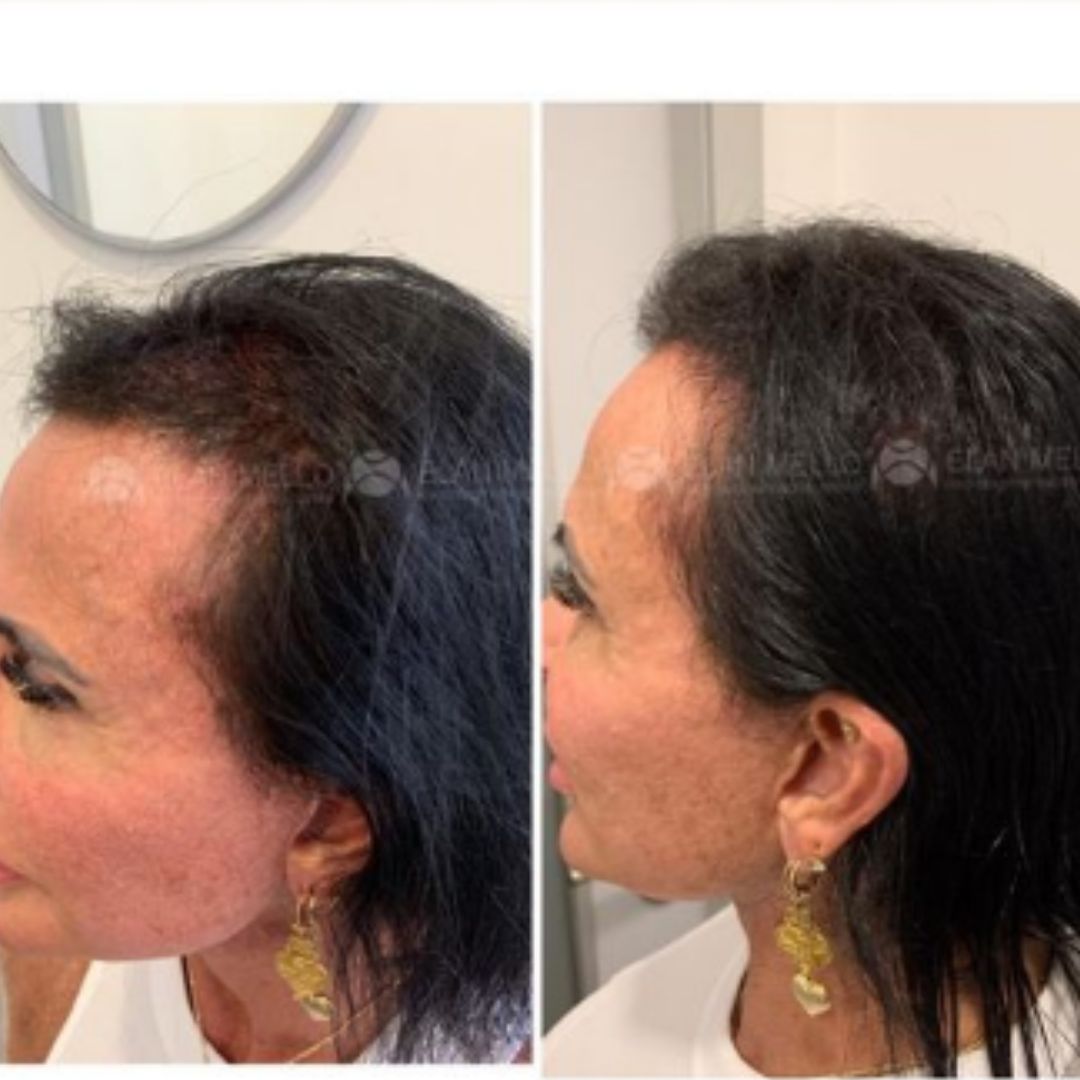 Procedimento capilar feito por Gretchen (Reprodução - Instagram)