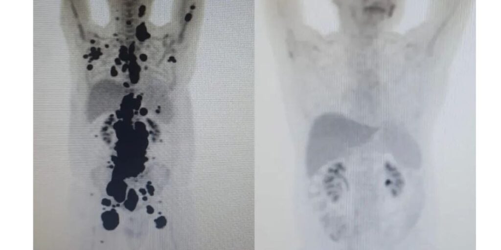 Exames mostram antes e depois de câncer de paciente (Foto: Reprodução / G1)