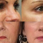 Botox Caseiro (Foto: Divulgação)