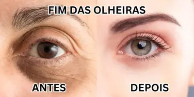 Adeus às olheiras ainda em 2023: Segredo com um único ingrediente popular vai eliminar a mancha em 2 passos