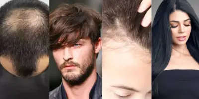 Adeus á calvíce para homens e mulheres: 4 sucos milagrosos para fazer o cabelo crescer em apenas 3 passos