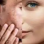 Pele com manchas / Pele sem manchas - Montagem TVFOCO