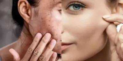 Levanta a pele caída e extermina qualquer mancha: Misturinha natural com 3 passos regenerar as 50+ no verão