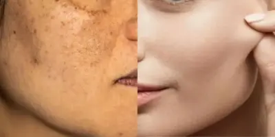 Extermina manchas escuras, o melasma e é melhor que laser: Receitinha natural com argila pra clarear pele