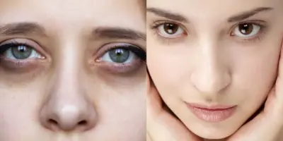 Rejuvenescimento de 15 anos garantido: Receitinha com único ingrediente popular dá adeus às temidas olheiras