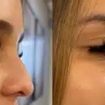 Técnica para mudar o nariz sem cirurgia plástica (Foto: Reprodução/ Internet)